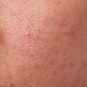 Open Pores